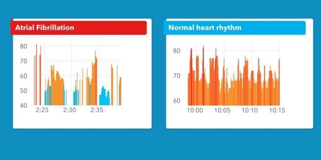 Apple Watch с точностью 97% могут определить нарушения сердечного ритма